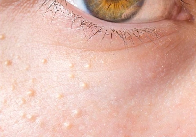 Milia Removal