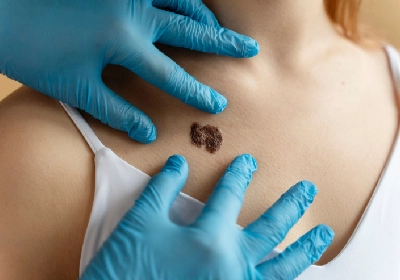 Mole-Removal