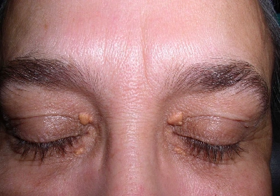 Xanthelasma