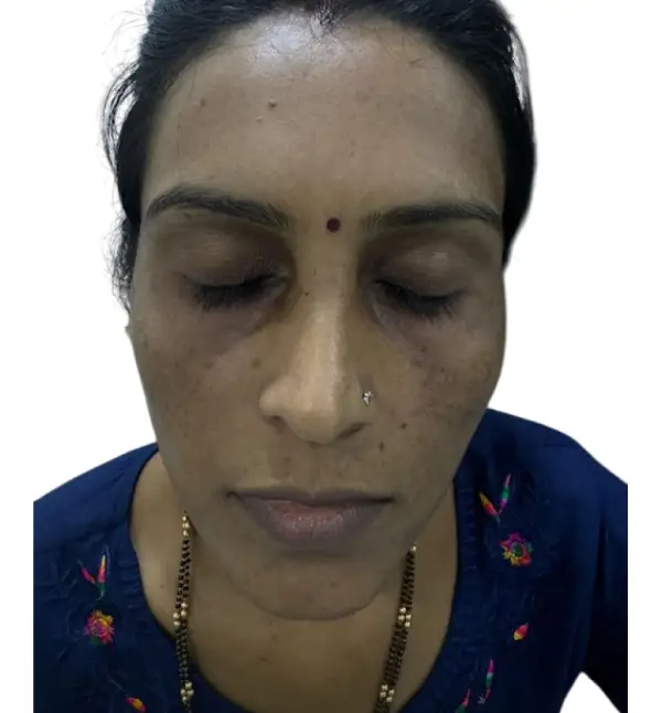 before treatment