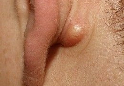 Cyst Removal