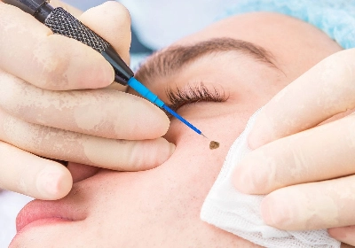 Skin Tag Removal