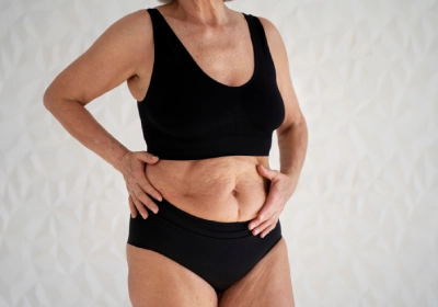 Stretch Mark Reduction