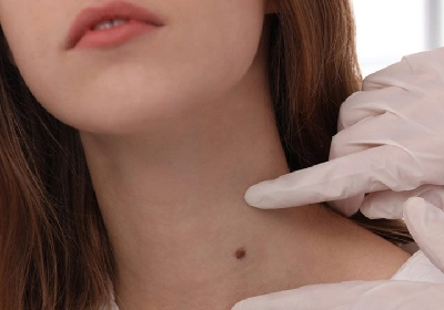 Wart Removal
