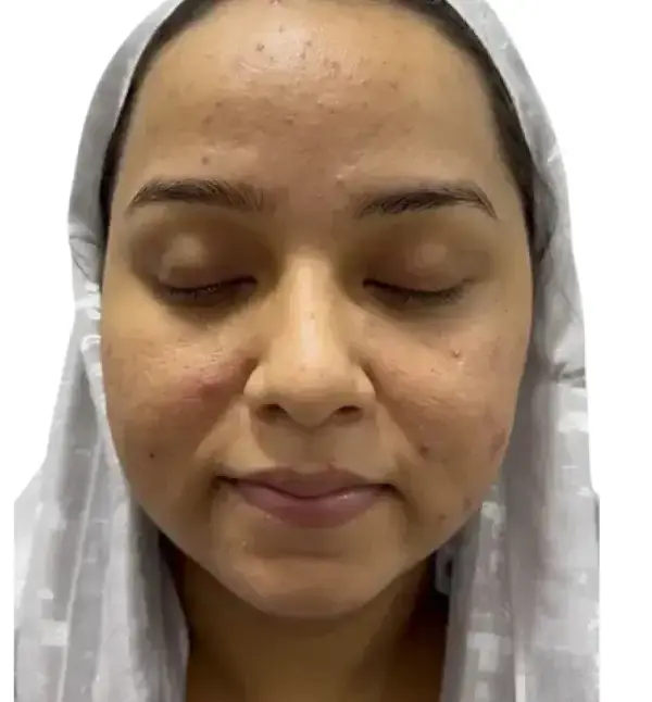 before treatment